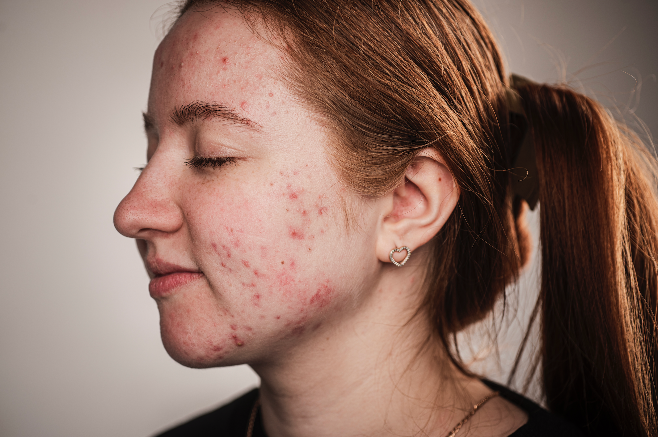 Sivilce Sebepleri Nelerdir?