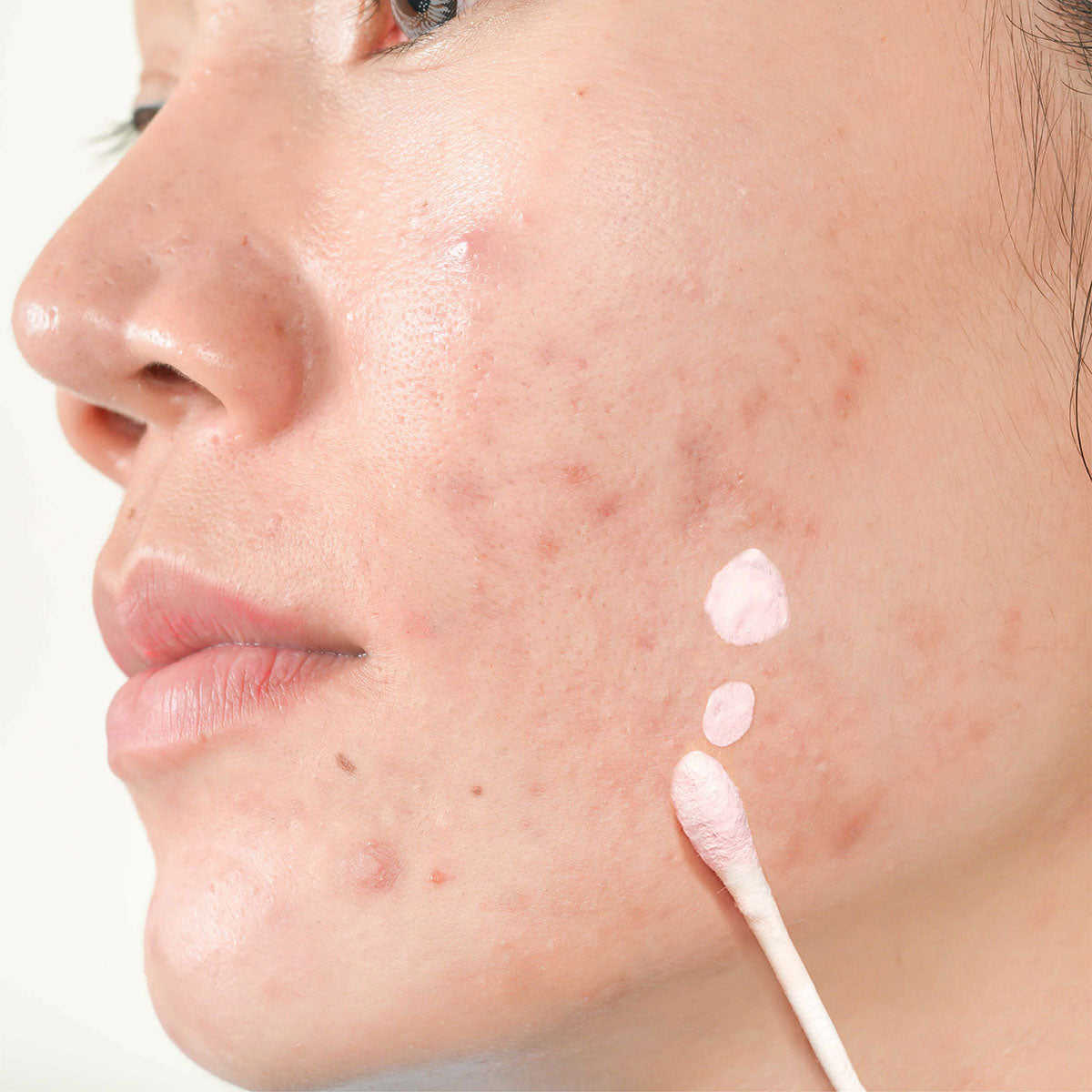 Akne Karşıtı Losyon