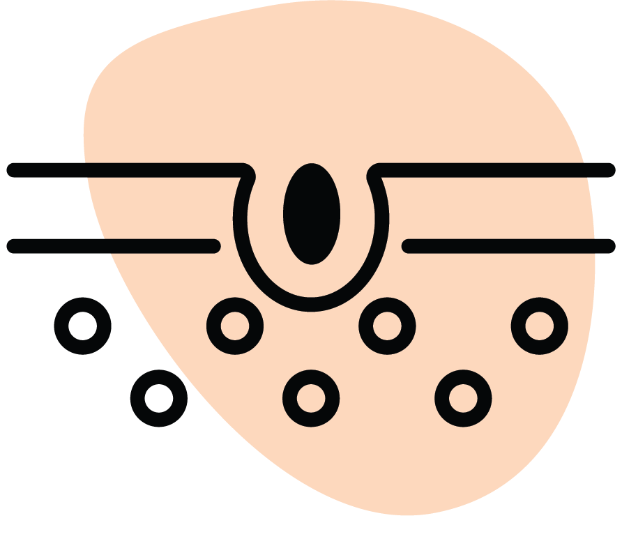 Siyah Nokta Arındırma